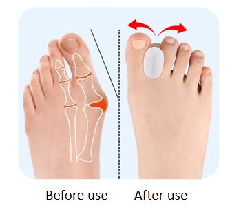 Hallux Valgus tåspridare, 6-pack